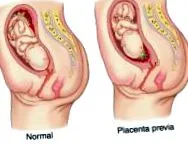 praevia placenta
