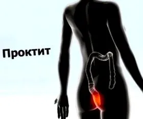 проктитис