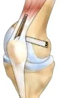 ligament