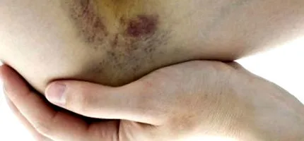 purpura