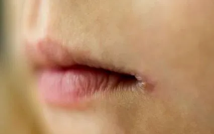 хеилитис