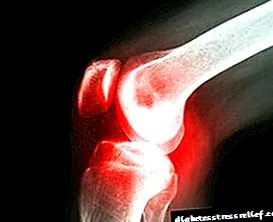 osteoartróza osteoartróza