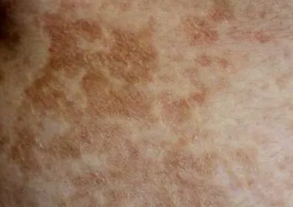 furazolidone diéta