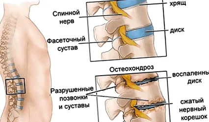 legg-calvé-perthes