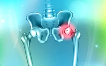 arthritis arthritis
