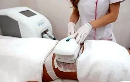 cryolipolysis