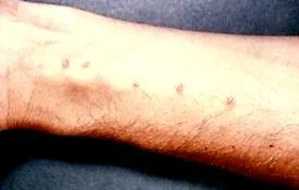 schistosomiasis