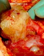 cystadenoma appendectomia