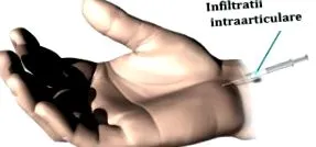 alagút