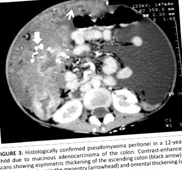pseudomyxoma