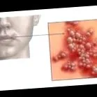 оваа инфекција
