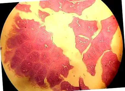 papilloma