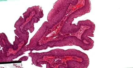 papilloma