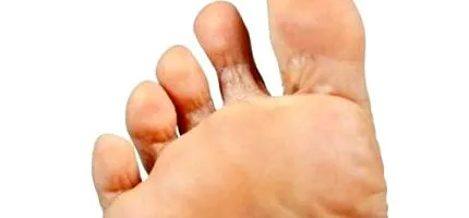 pedis