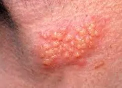 papilloma