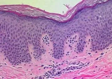 papillomatosis biopszia szemölcs
