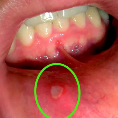 papilloma