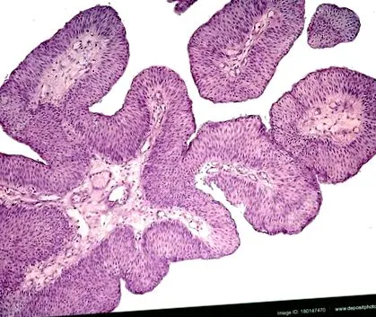 hólyag papilloma