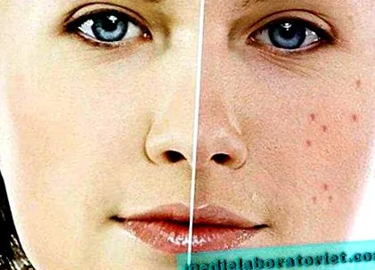 roaccutane