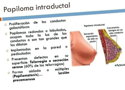 papilloma
