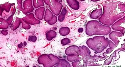 papillomatosis biopszia fertőzött