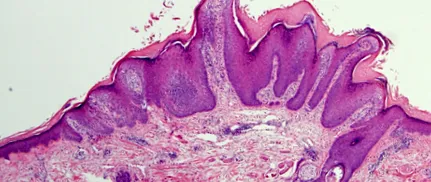 hyperkeratosis