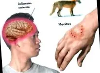 toxoplazmóza