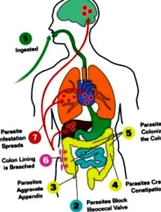 giardiasis