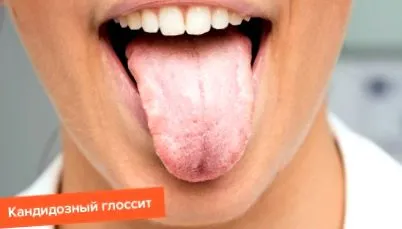 glossitis