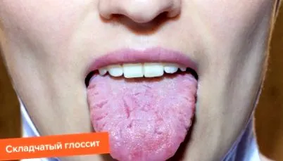 glossitis