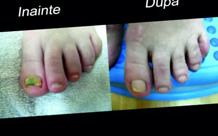 mycosis