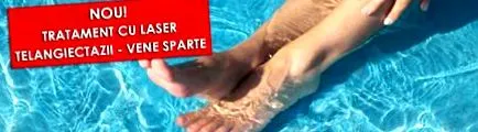 žiadna skleroterapia