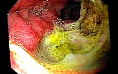 ulcer