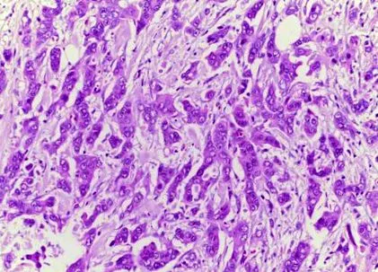 cystadenoma apokrin