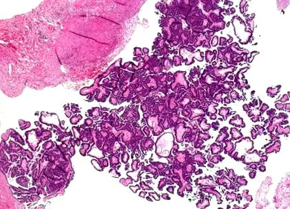 apokrin cystadenoma