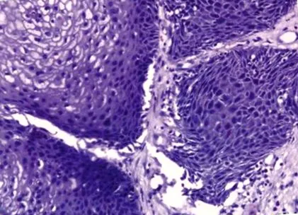 tumor cystadenoma