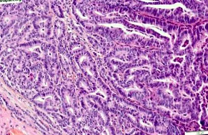 apokrin tumor