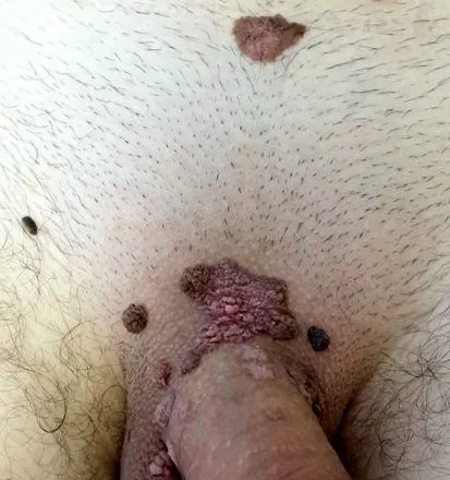 papilloma papilloma
