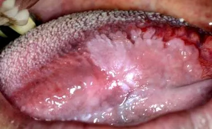 papilloma szajban