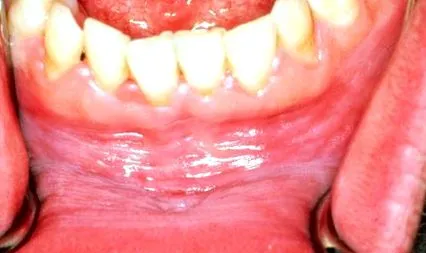 papilloma