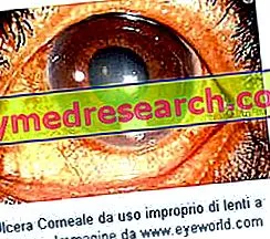 keratoconus
