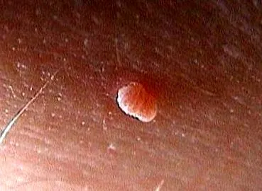 fibroepithelialis polip