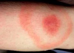 allergia