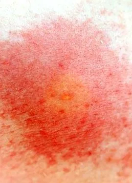 allergia