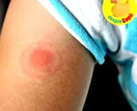 allergia