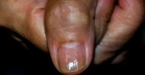 helyi trauma