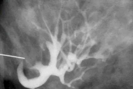 papilloma