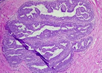 papilloma malignus