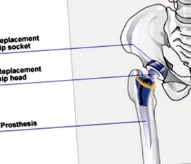 osteoarthritisben