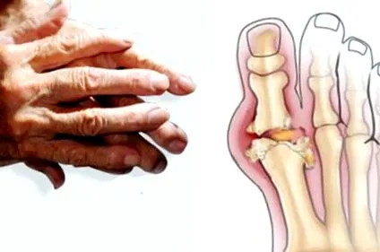 osteoarthritist